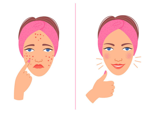 How to Evaluate the Safety and Efficacy of Your Acne Cream?